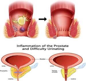 How To Relieve Hemorrhoid Irritation