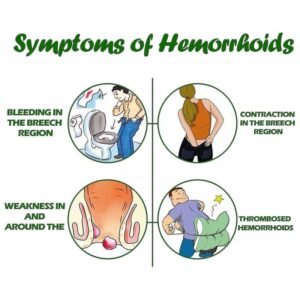 How To Relieve Hemorrhoid Itching