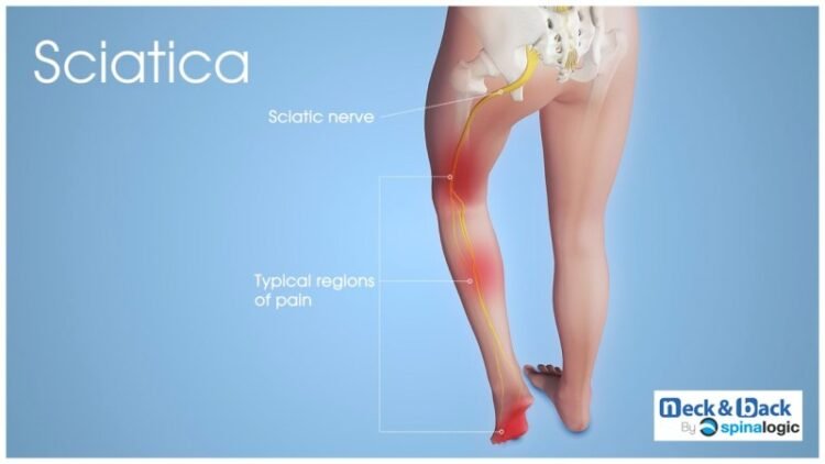 Ways To Help Relieve Sciatic Nerve Pain
