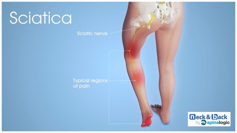 Ways To Help Relieve Sciatic Nerve Pain Ways To Help Relieve Sciatic Nerve Pain