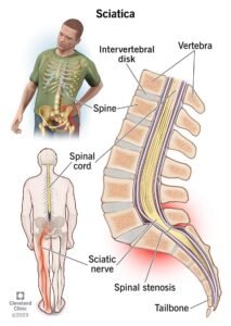 Severe Lower Back Pain When Getting Up From Sitting