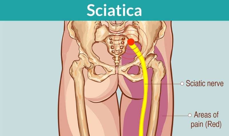 How To Relieve Sciatica Inflammation