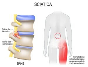 How To Relieve Sciatica When Sitting