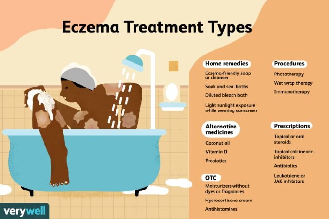 How To Treat Really Bad Eczema