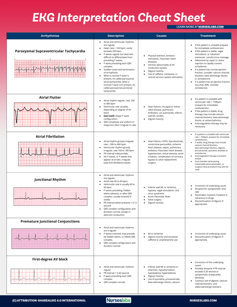 Interpreting 12 Lead Ecgs Made Easy