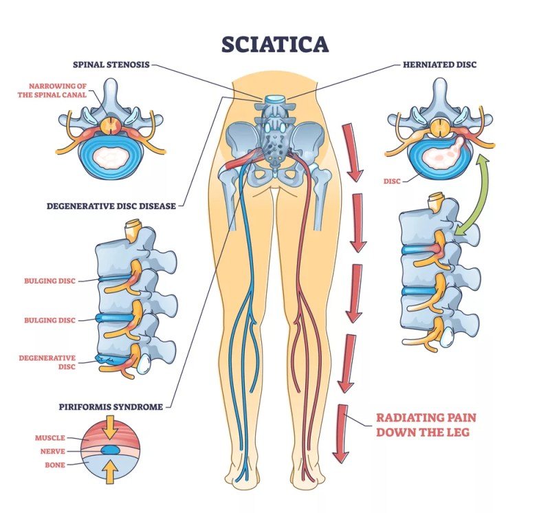 Natural Ways To Relieve Sciatica Pain Natural Ways To Relieve Sciatica Pain