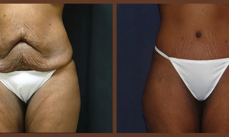 Plastic Surgery Post Gastric Bypass Plastic Surgery Post Gastric Bypass