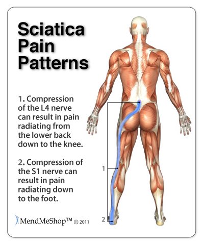 Relieve Severe Sciatic Nerve Pain