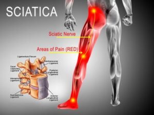 What Exercises Relieve Sciatica Pain
