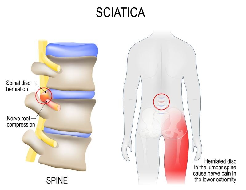 Best Exercises To Relieve Sciatica Pain Best Exercises To Relieve Sciatica Pain
