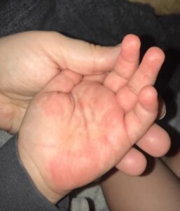 How To Treat Bad Eczema On Hands