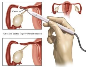 Ways To Get Pregnant With Tubes Tied