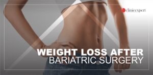 How To Lose Belly Fat After Back Surgery