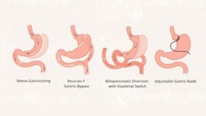 Pre Op For Gastric Bypass