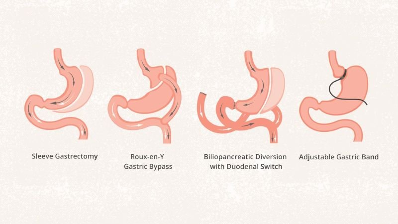 Pre Op For Gastric Bypass