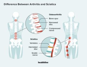 Severe Sciatic Nerve Pain Relief