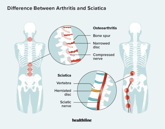 Severe Sciatic Nerve Pain Relief