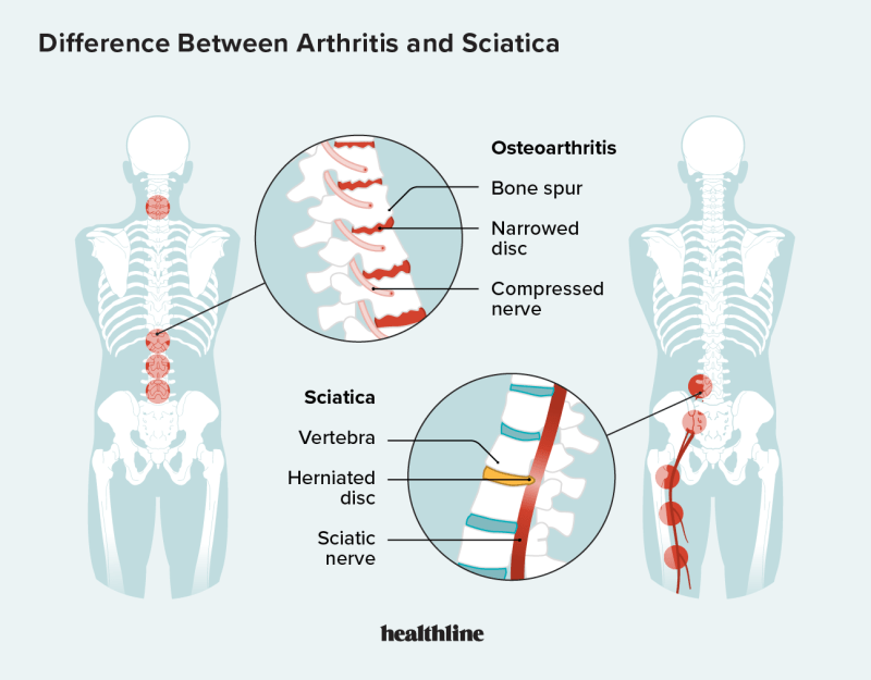 Severe Sciatic Nerve Pain Relief Severe Sciatic Nerve Pain Relief